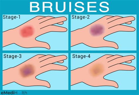 bruise dating is scientifically precise